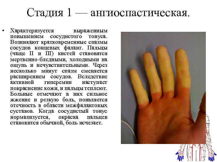Стеноз шейного отдела позвоночника: симптомы, лечение и операции, упражнения для профилактики шейного стеноза (сосудов и артерий шеи), прогноз – отделение вертебрологии цкб ран
