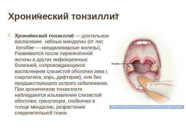 Увеличенные миндалины у ребенка или взрослого — причины боли в горле, температуры, лечение в клинике
