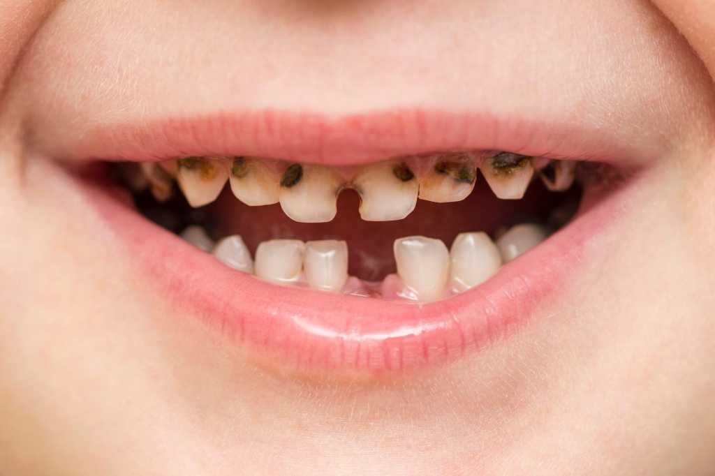 К чему снятся зубы: гнилые, сломанные, выпавшие, шатающийся и др
