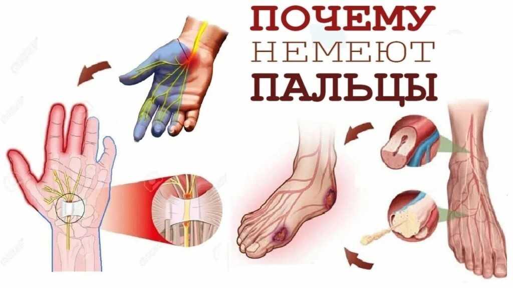 После операции немеют пальцы. Онемение конечностей руки. Болит рука и немеют пальцы.