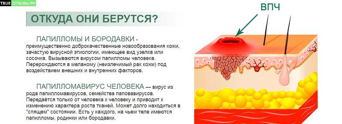 Папилломатоз: методы диагностики и лечения, консультация в клинике «евроонко» | клиники «евроонко»