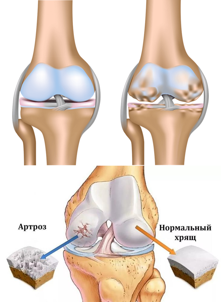 Фото артроза коленного сустава 2 степени