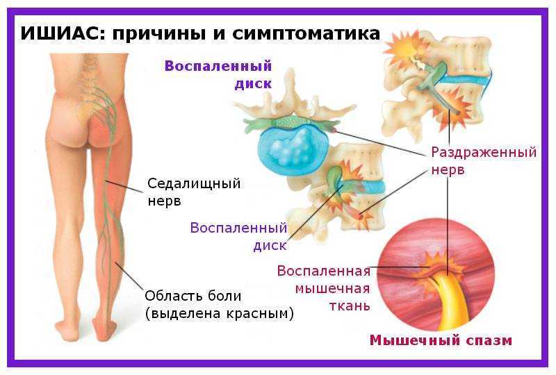 Обследование позвоночника, спинного мозга и нервных сплетений - медицинский центр «эхинацея»