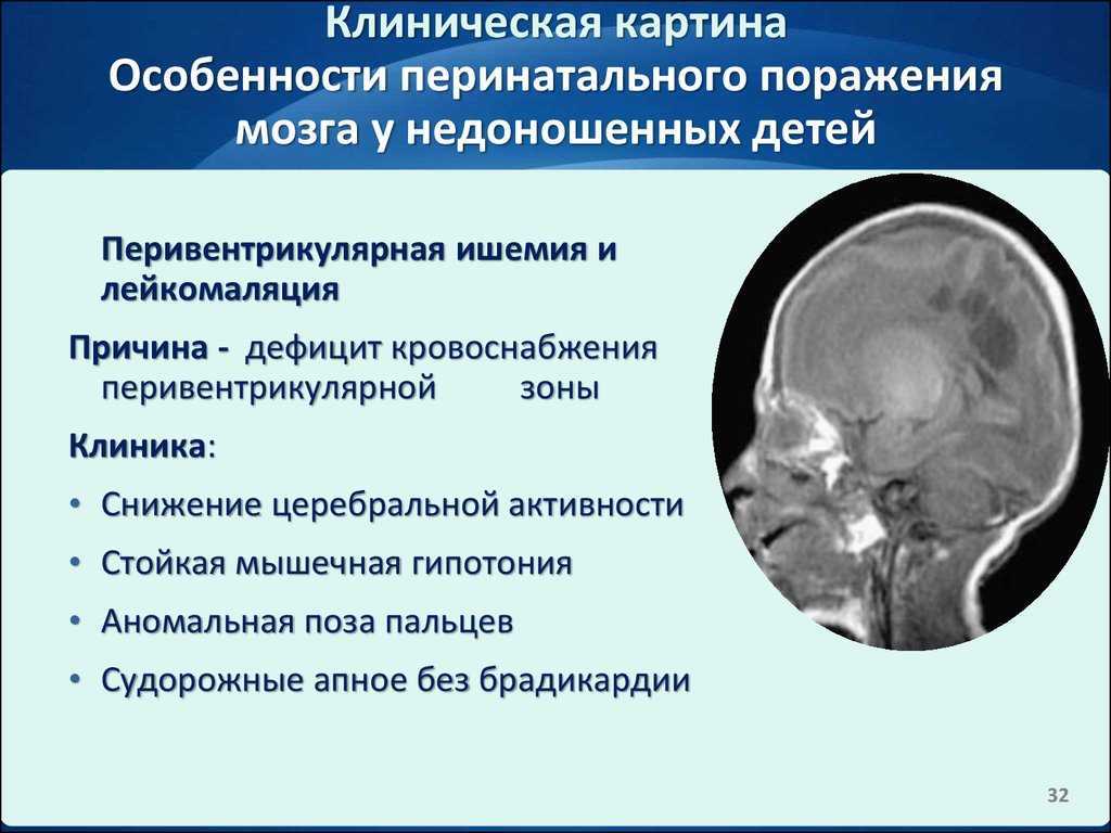 Поражение мозга