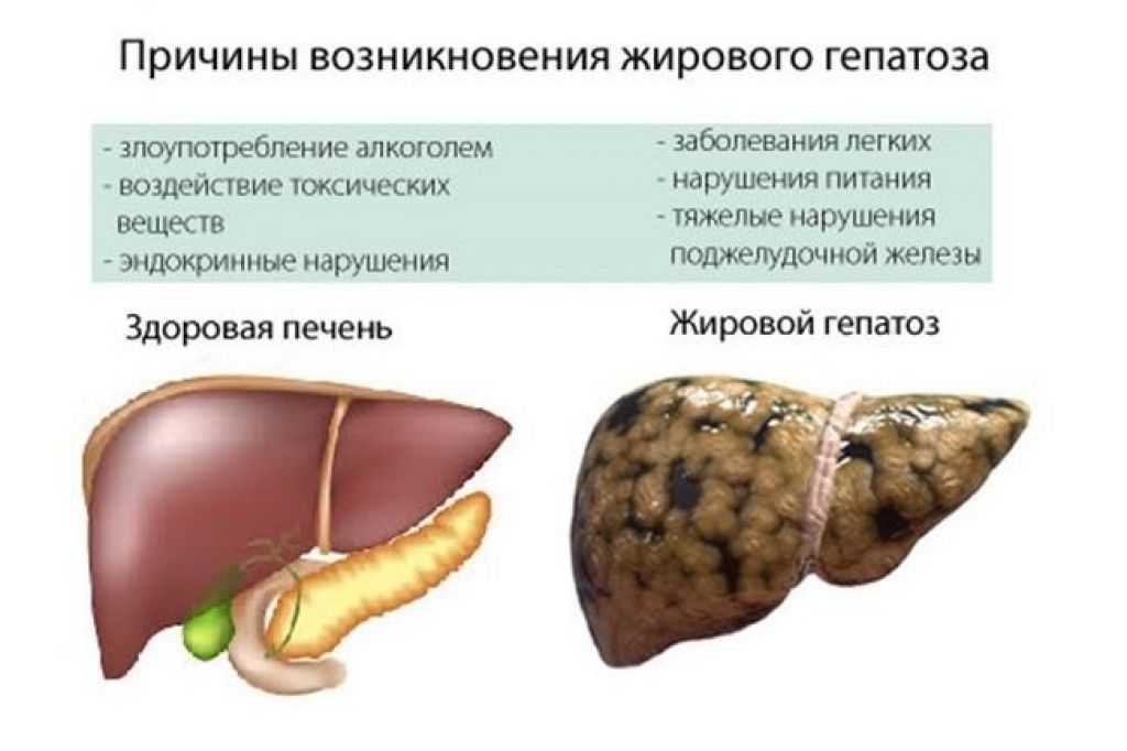 Увеличение печени. симптомы и лечение гепатомегалии печени.