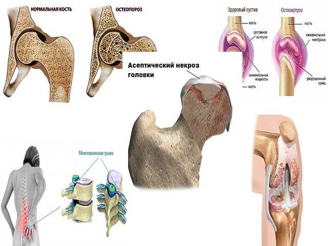 Болят кости причина. Боль в суставе тазобедренная кости. Остеопороз головки бедренной кости. Остеопороз тазобедренного сустава. Боль в бедренном суставе.