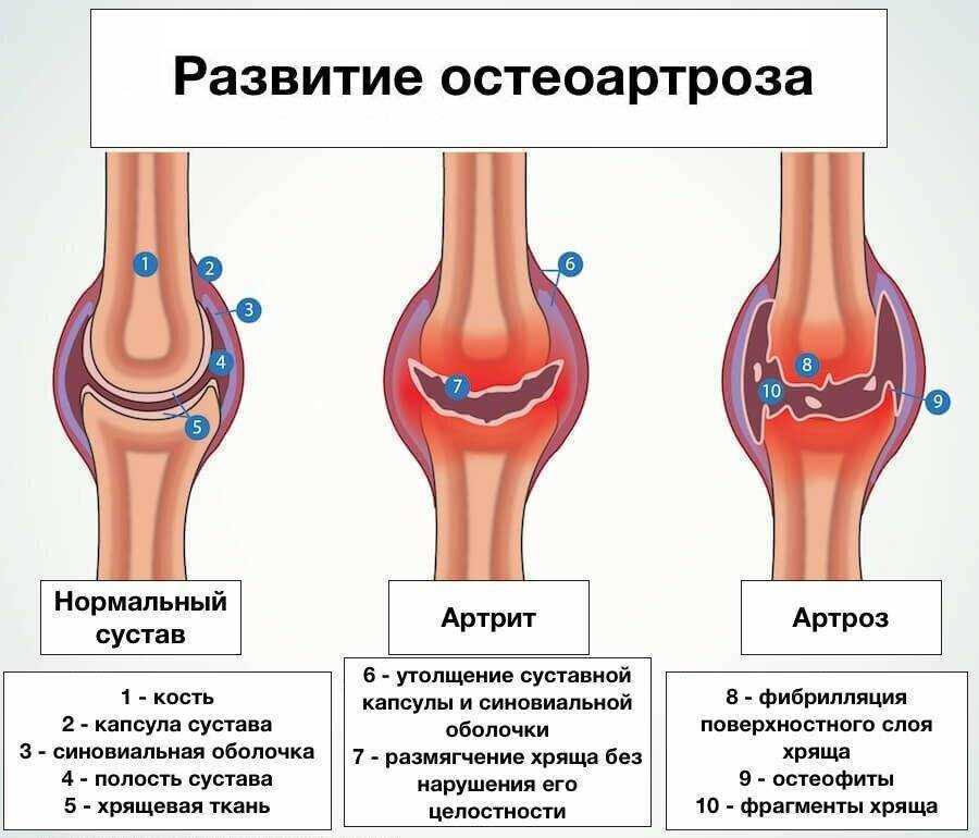 Наиболее яркая картина синовита с частыми обострениями наблюдается при остеоартрозе