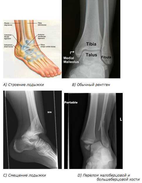 Перелом наружной лодыжки рисунок