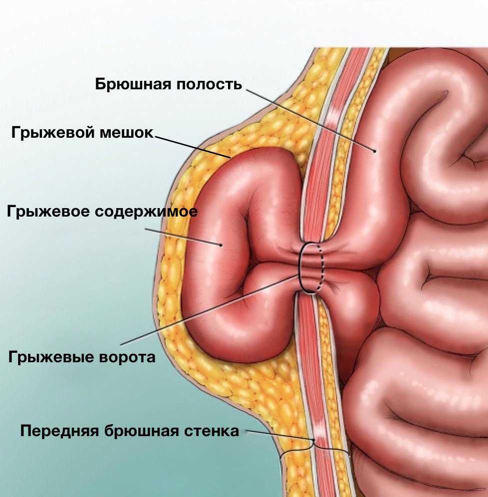 Пупочная грыжа рисунок схема