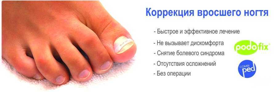 Вросший ноготь. лечение
