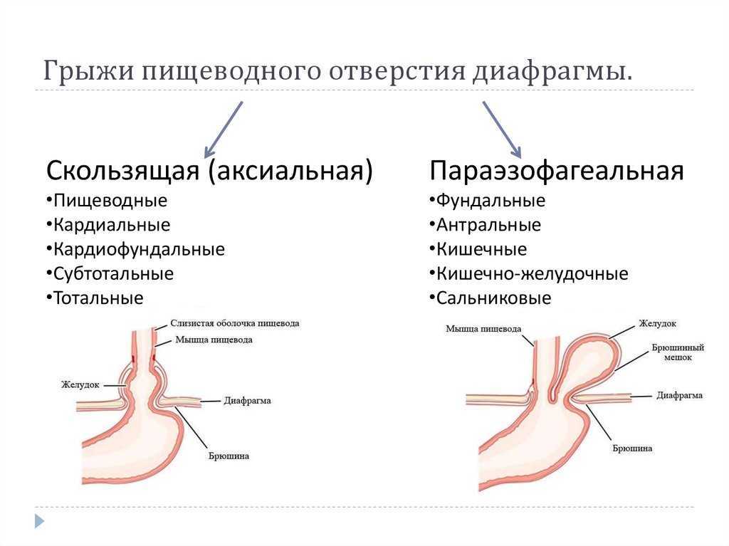 Эндоскопическая картина при грыжах пищеводного отверстия диафрагмы характеризуется