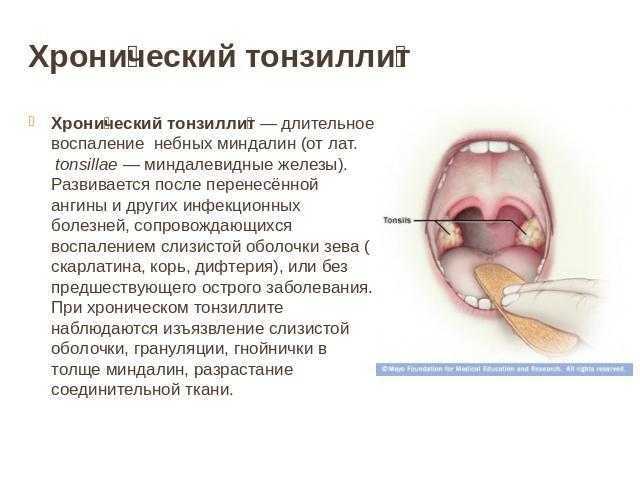 Острый и хронический тонзиллит - лечение и симптомы, осложнения после заболевания.