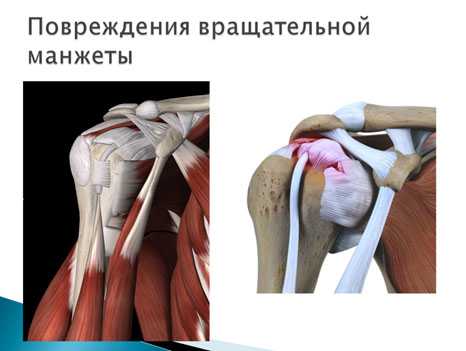 Разрыв манжеты плечевого. Ротаторная манжета плечевого сустава. Ротаторная манжета плечевого сустава разрыв. Мышцы ротаторной манжеты плечевого сустава. Повреждения плеча вращательной манжеты s46.