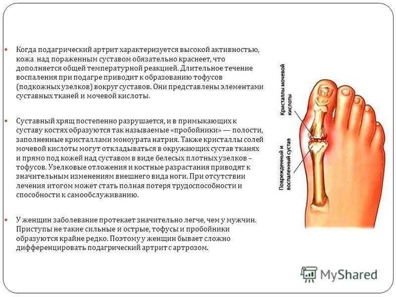 Могут ли болеть суставы. Плюснефаланговый сустав подагра. Первый плюснефаланговый сустав при подагре.