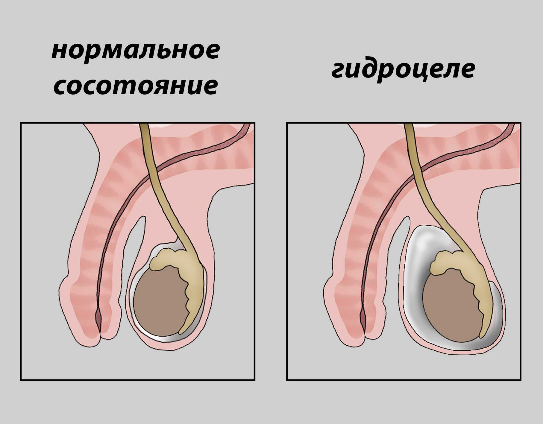 если одно яйцо больше другого у члена фото 69