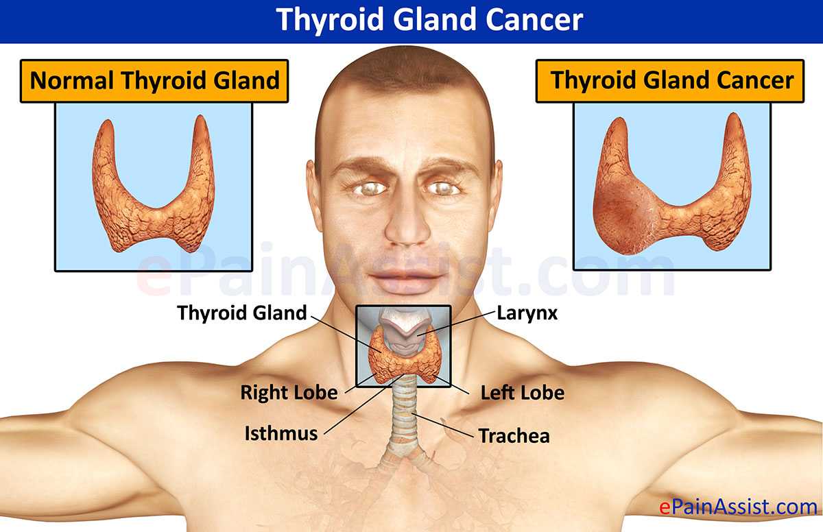 Признаки щитовидки у мужчин лечение. Rak Shitovidnoy jelezi. Опухоль щитовидной железы. РПК зитовидной железы симпомы. Опухоль щитовиднойсжелезы.