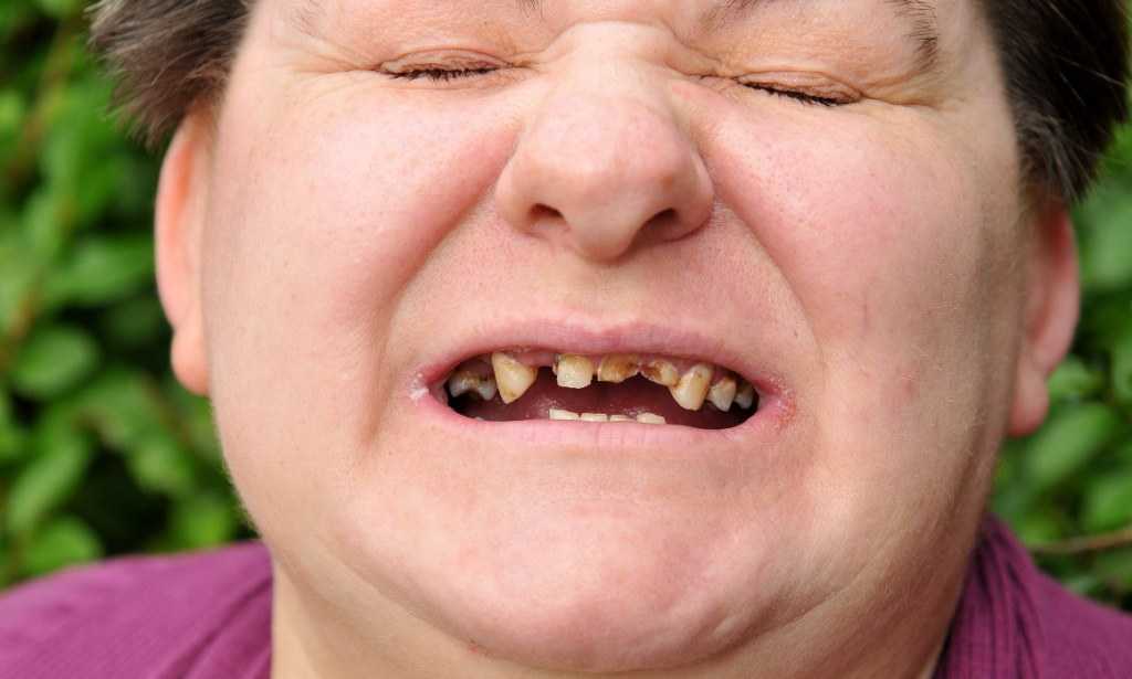 К чему снятся гнилые зубы, что означает такое сновидение - самое полное трактование Гнилые зубы во сне - почему, что делать, если приснились