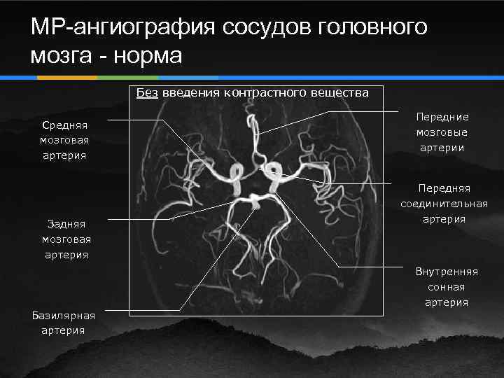 Сегмент а1 пма. Мрт ангиография артерий головного мозга. Сегменты среднемозговой артерии кт схема. Мрт ангиография сосудов головного мозга анатомия. Задние соединительные артерии головного мозга на кт.
