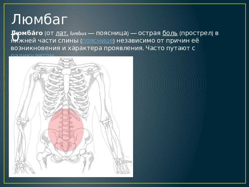 Люмбаго с ишиасом что за диагноз. Люмбаго. Люмбаго поясничный прострел.