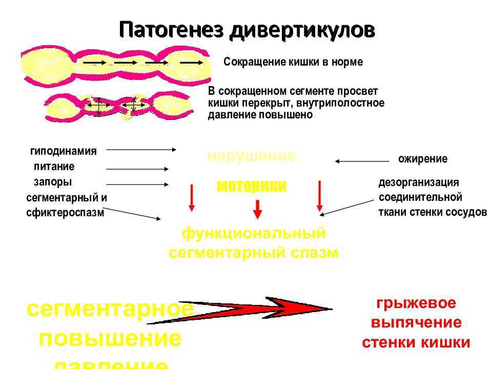 Схема лечения дивертикулита
