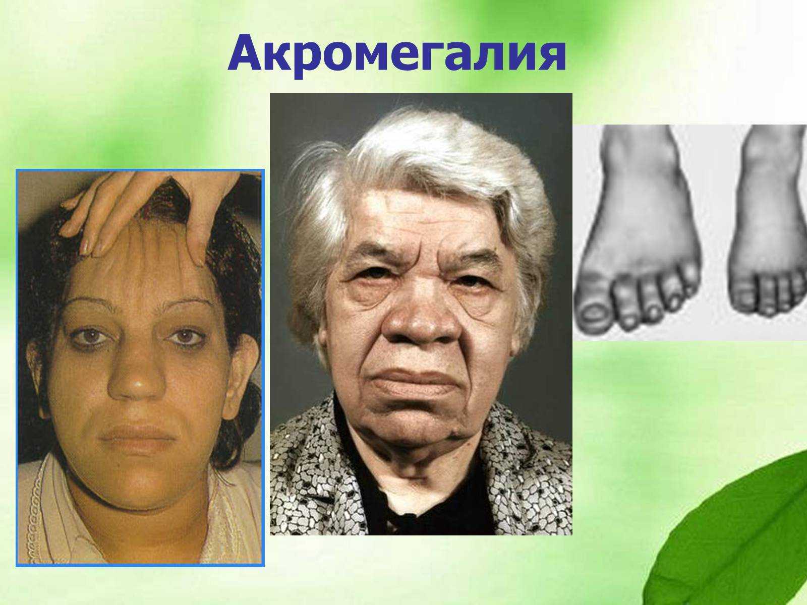 Акромегалия