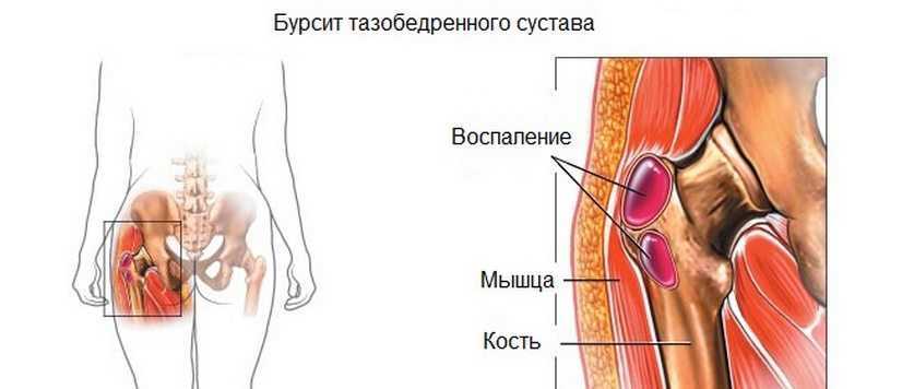 Боль в тазобедренном суставе: причины, лечение, что делать и как лечить