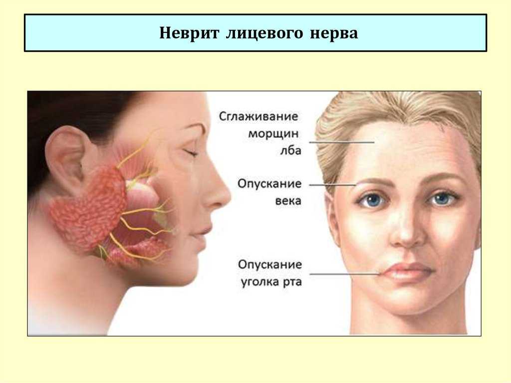 Неврит лицевого нерва локальный статус карта