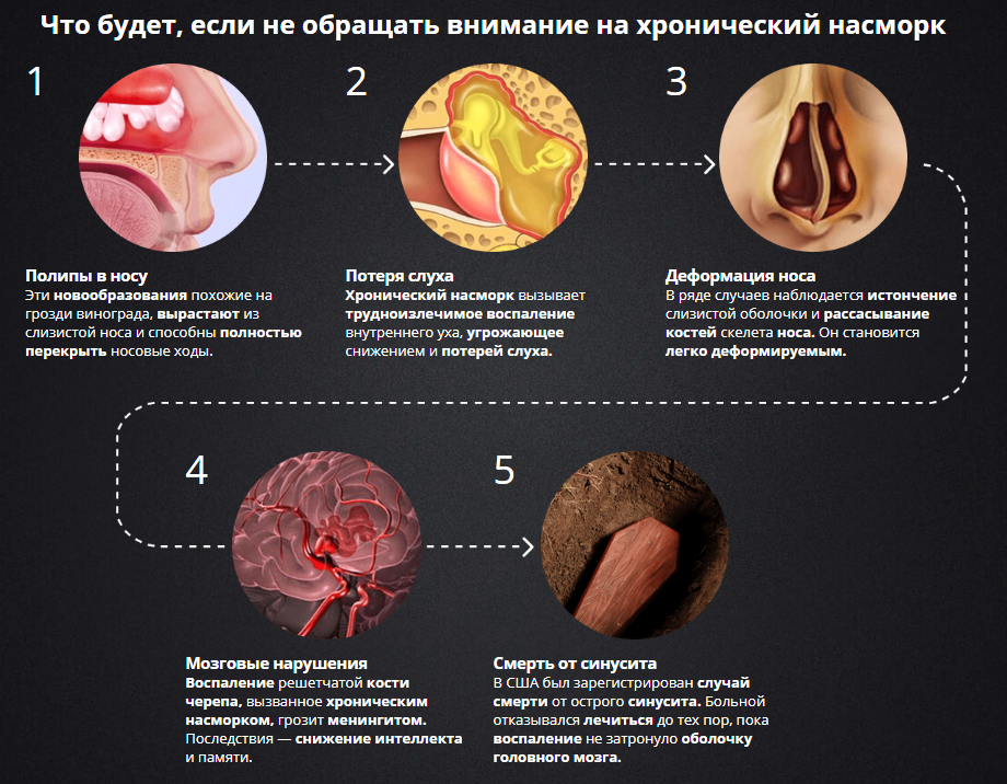 Лечение вазомоторного ринита (длительного насморка) - симптомы и причины