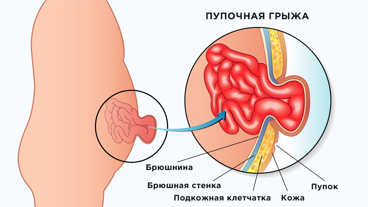 Пупочная грыжа у взрослых: симптомы, фото, лечение. когда нужна операция?