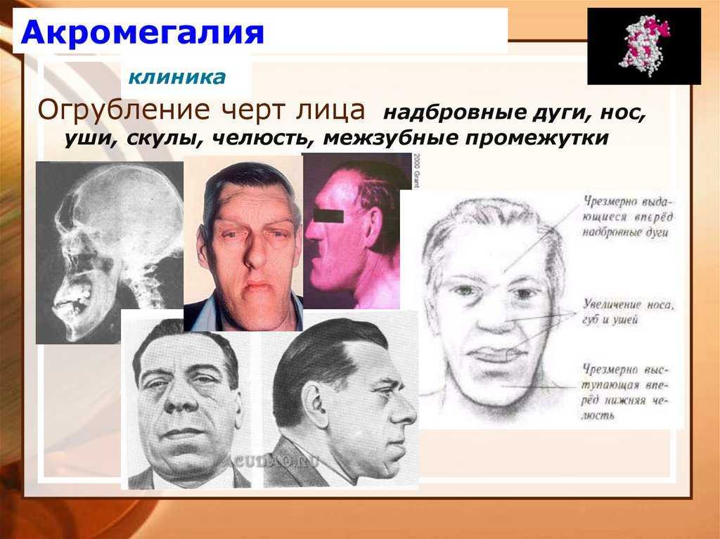 Методы выявления остеопороза?
