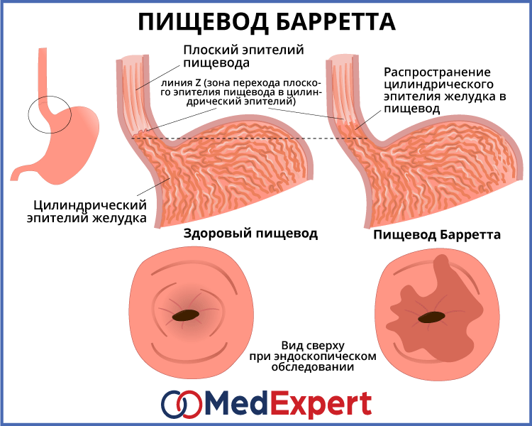 Схема лечения гэрб с эзофагитом