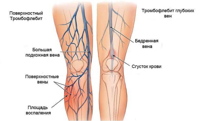 Венозная недостаточность нижних конечностей