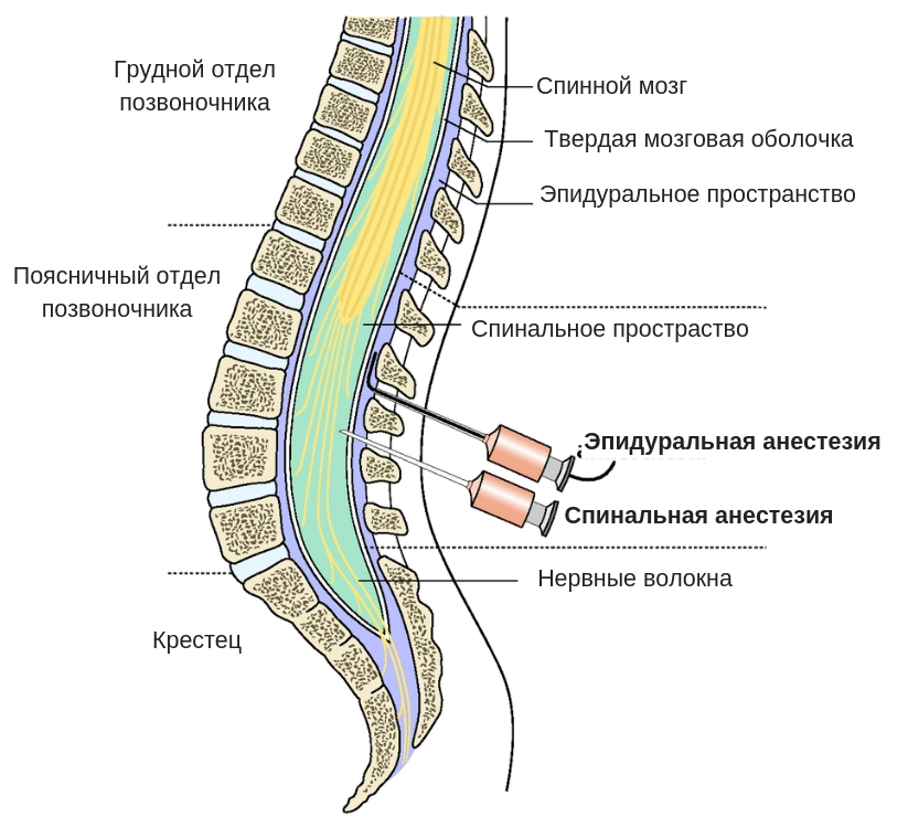 Эпидуральная анестезия картинки