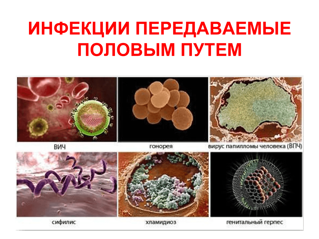 Заболевания передающиеся половым путем картинки