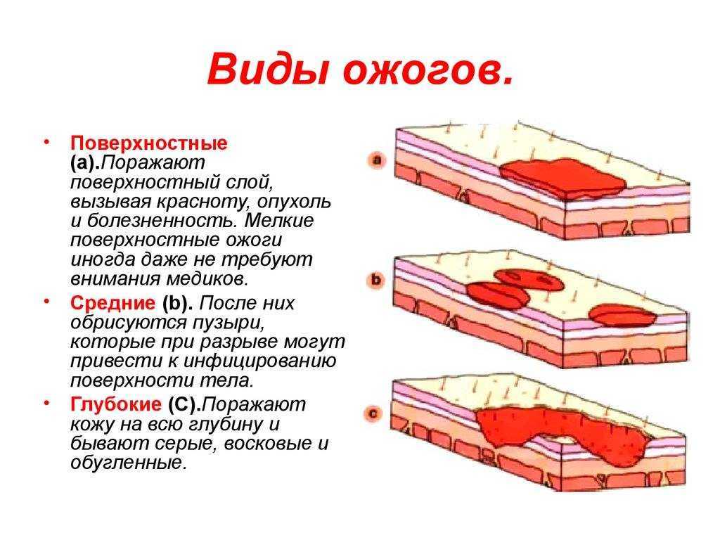 Первая помощь при поражении радиацией, отравляющими веществами, при химических и термических ожогах, обморожении | учебник 11 класс ким с.в.