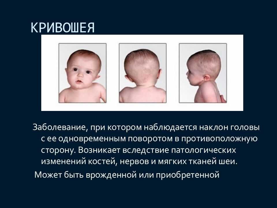 Врожденное или приобретенное заболевание младшего детского возраста, при котором возникает искривление шеи в виде неправильного положения головы набок и в сторону