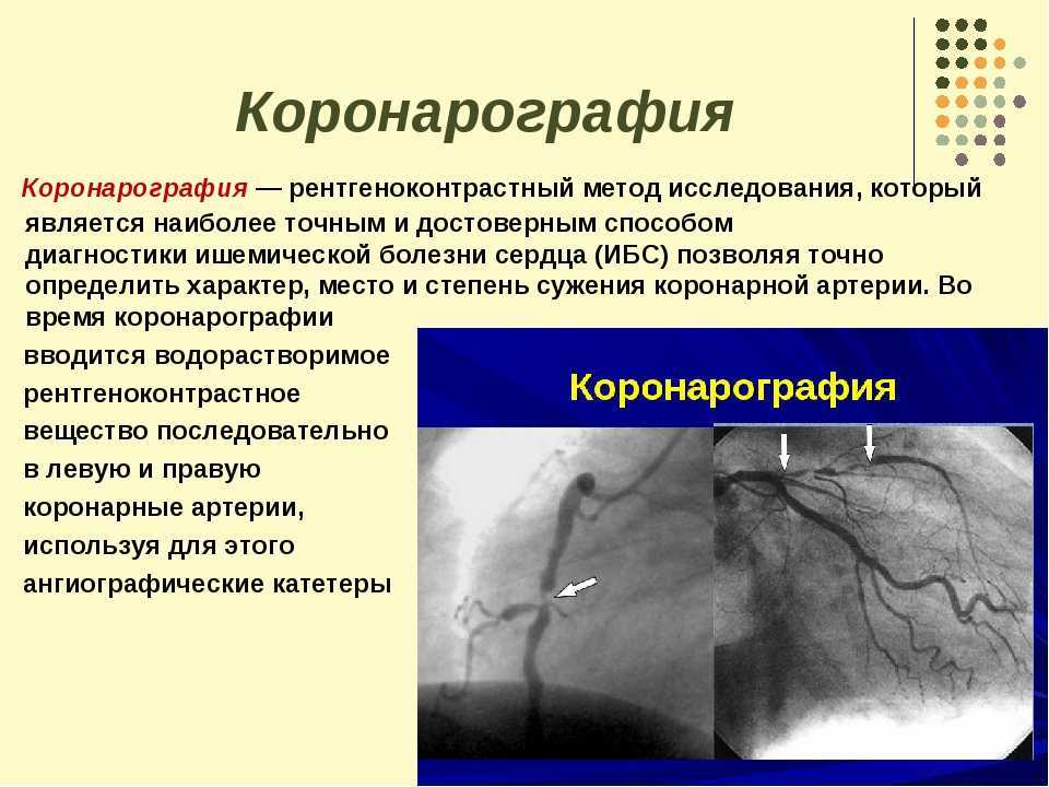 Коронарография сосудов сердца: что это, и когда проводят процедуру?