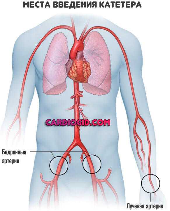 Как делают коронографию. Коронарография места введения. Осложнения коронарографии. Коронарография через бедренную артерию.