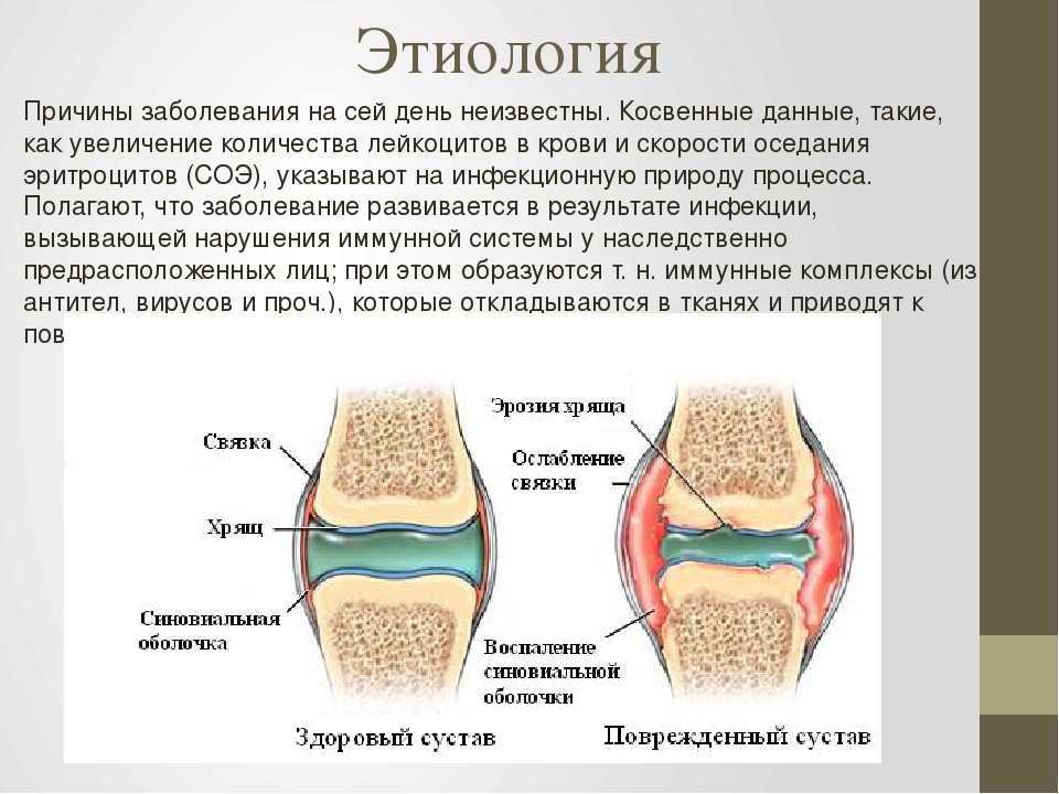 Ревматоидный артрит презентация терапия