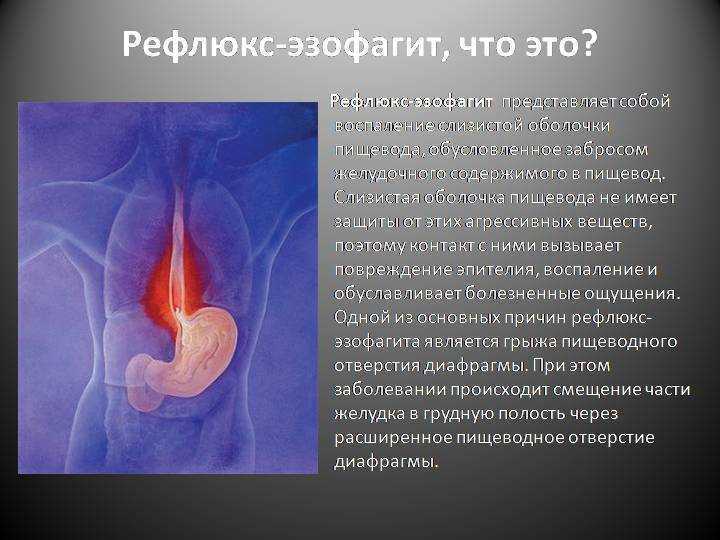 Что надо знать о гастроэзофагельной рефлюксной болезни