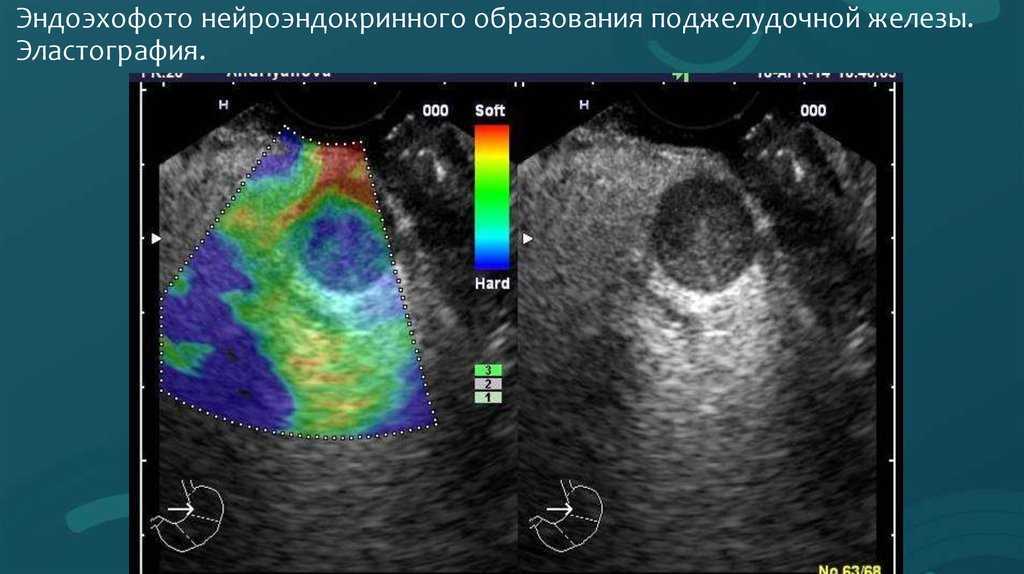 Главное осложнение сахарного диабета – недостаток знаний о нём