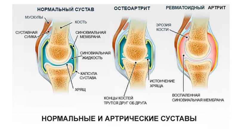 Боль в суставах (артралгия) : симптомы, причины и лечение