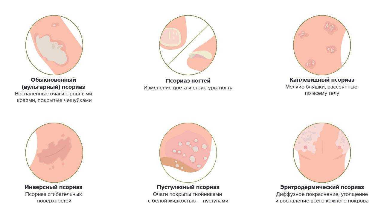 Псориаз: причины возникновения и лечение заболевания