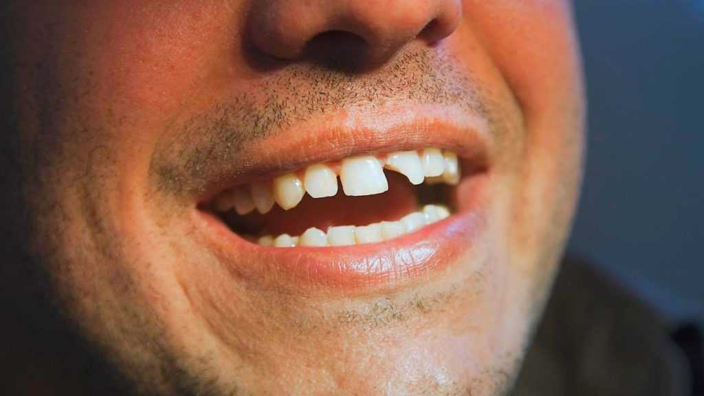 К чему снятся гнилые зубы во рту у себя или другого человека - сонник | spacream.ru
