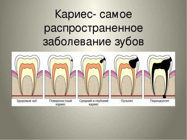 Зубки корень. Заболевание поражающее эмаль и дентин зубов. Заболевания зубов схема. Кариозные поражения зубов кариес.