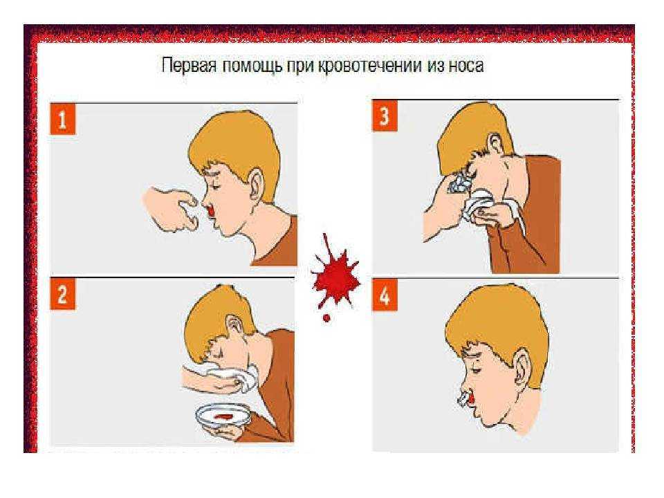 Какие действия необходимо выполнить при носовом кровотечении