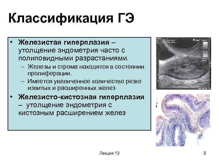 Гиперплазия эндометрия матки презентация