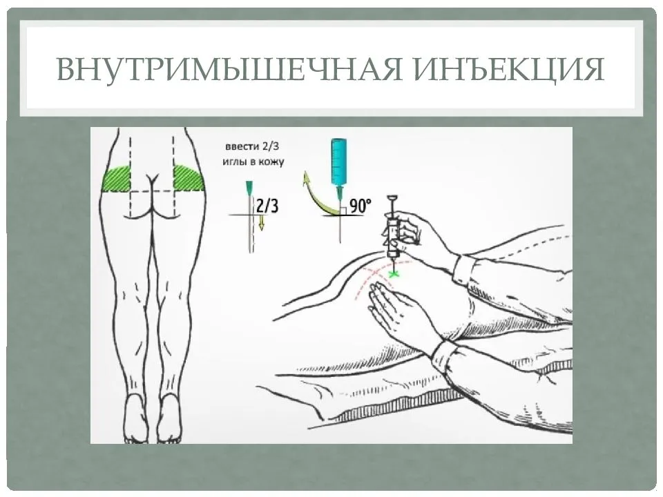 Схема постановки уколов в ягодицу