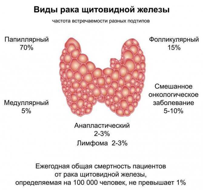 Округлые очаги разрастания ткани щитовидной железы - образования могут иметь капсулу, отделяющую их от окружающей ткани, или быть наполнены коллоидной жидкостью и 95% узлов доброкачественные и не несут опасности для жизни