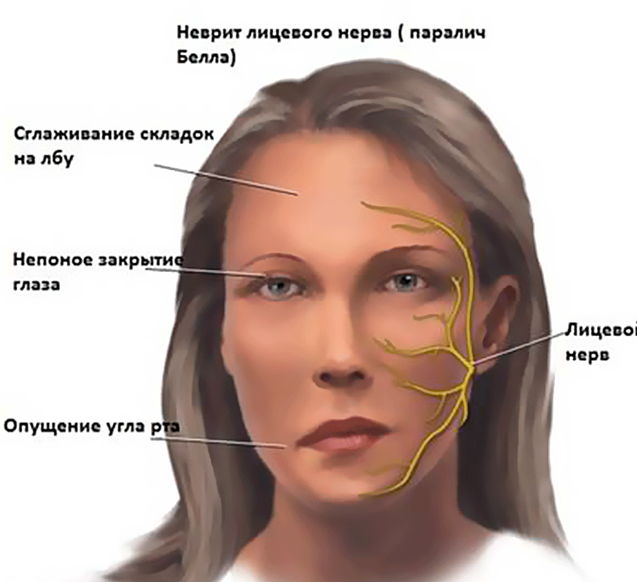 Неврит тройничного нерва симптомы